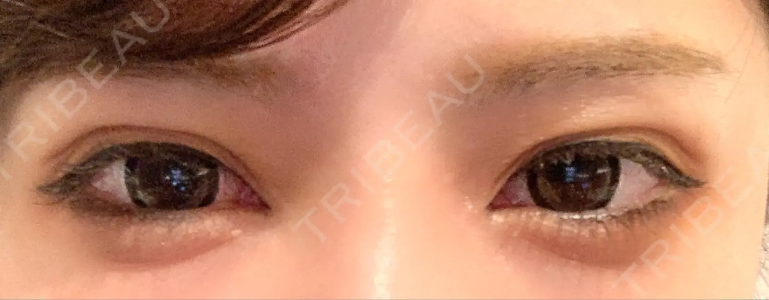 施術後の写真