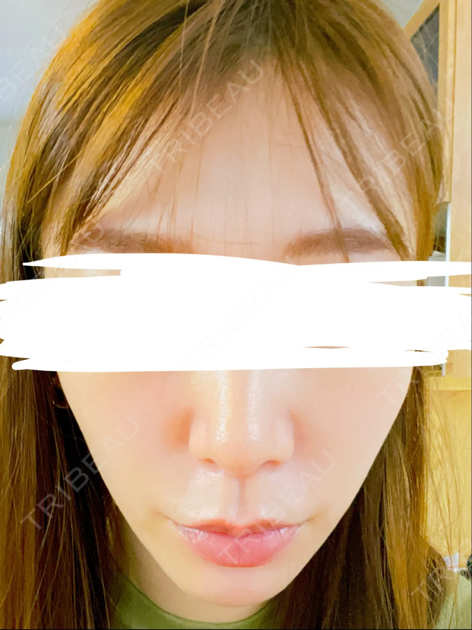 施術後の写真