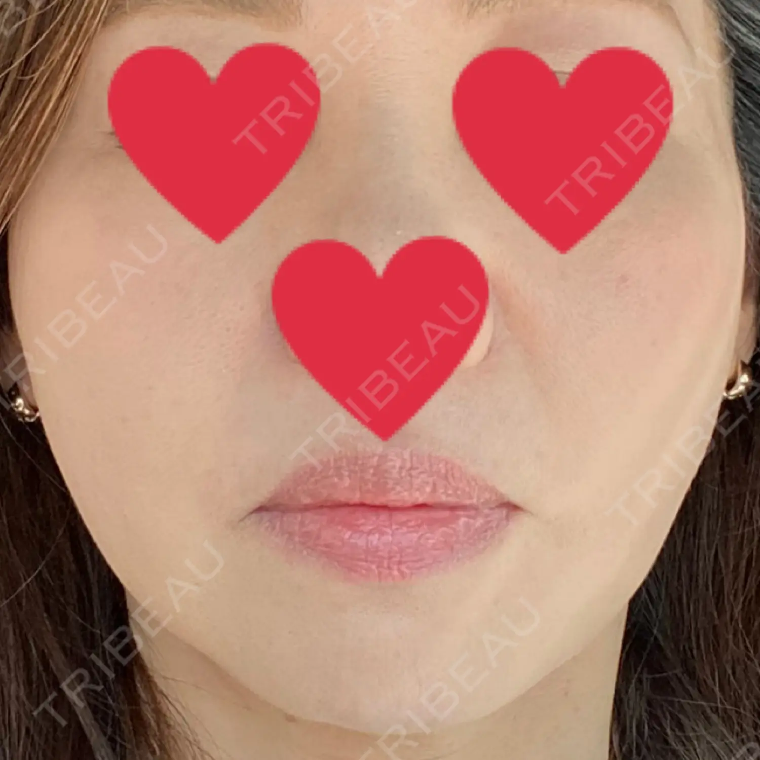 施術後の写真