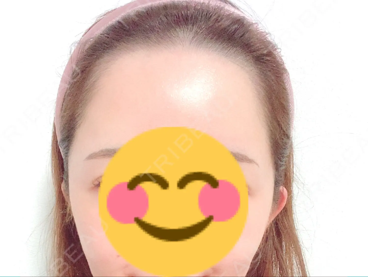 施術後の写真
