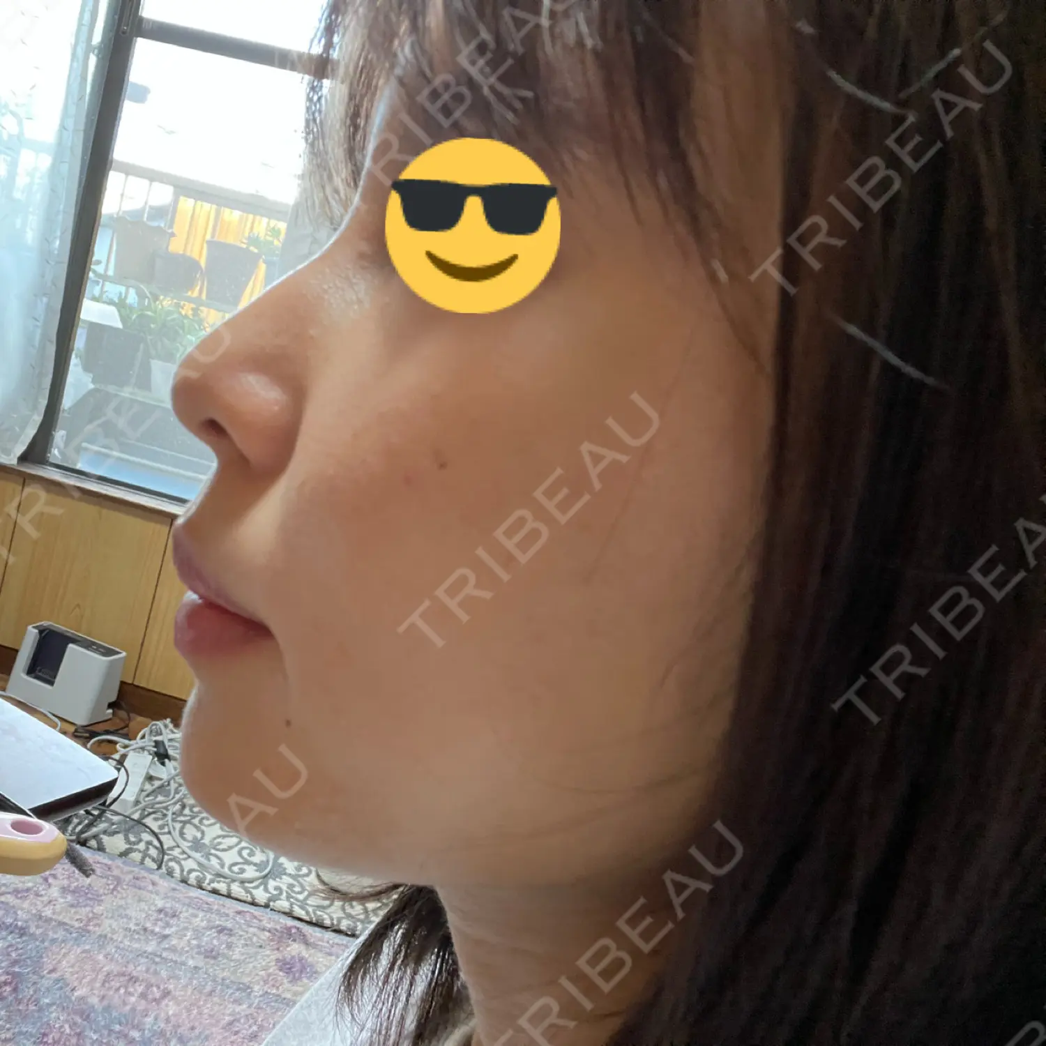施術後の写真