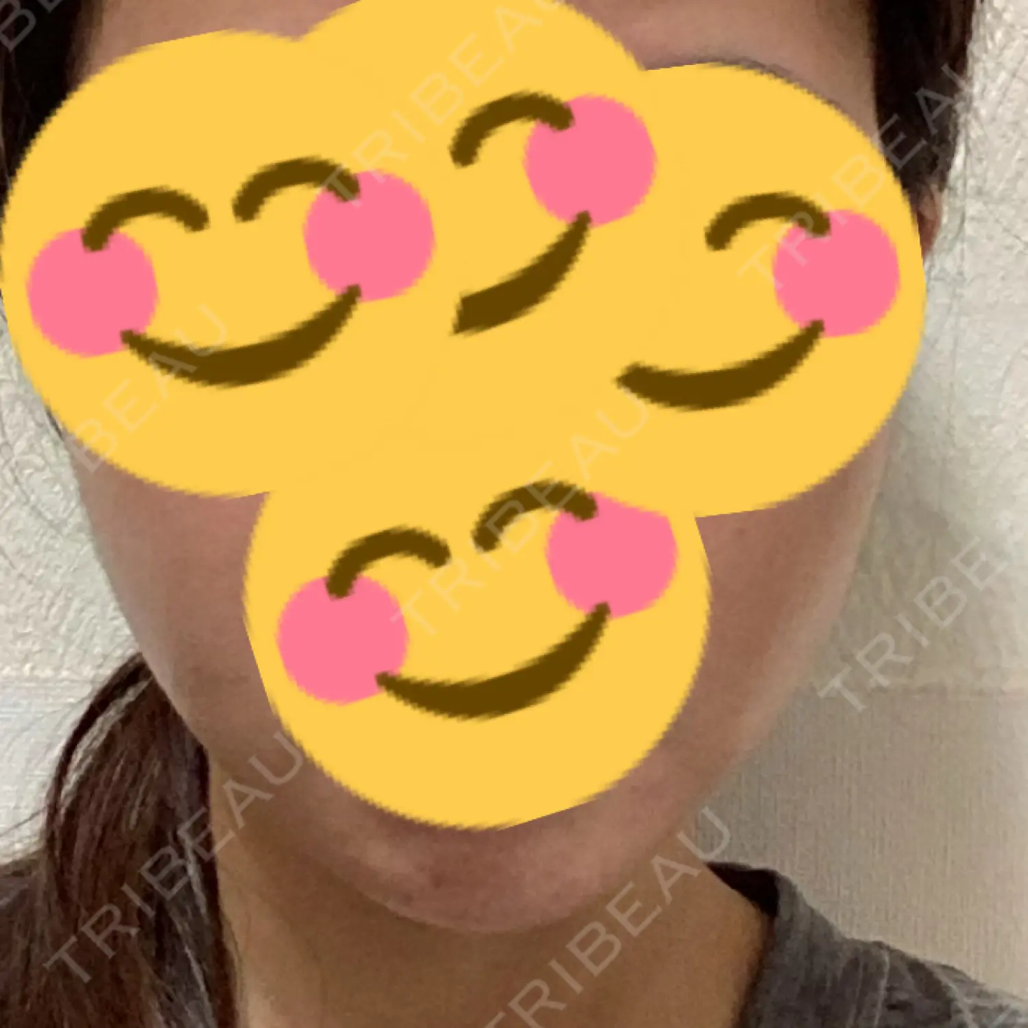 施術後の写真
