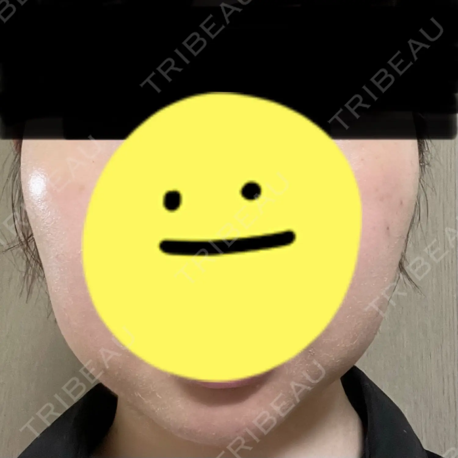 施術後の写真