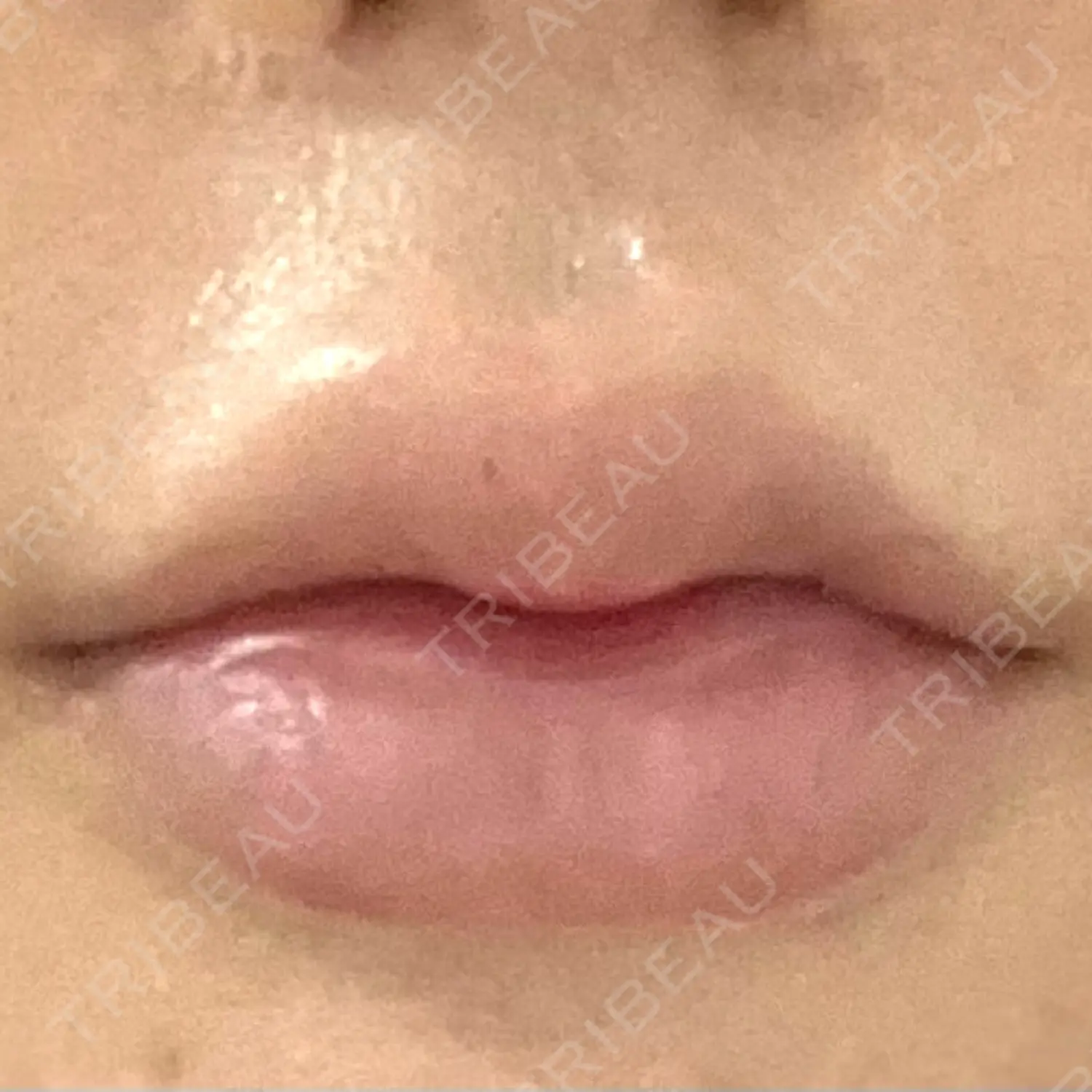 施術後の写真