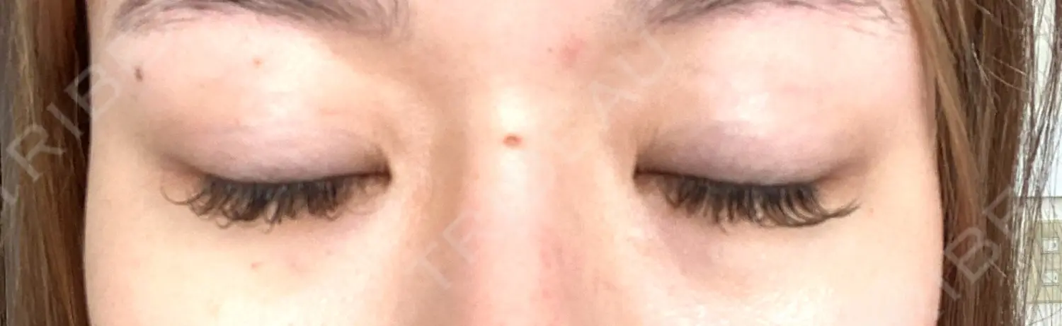 施術後の写真