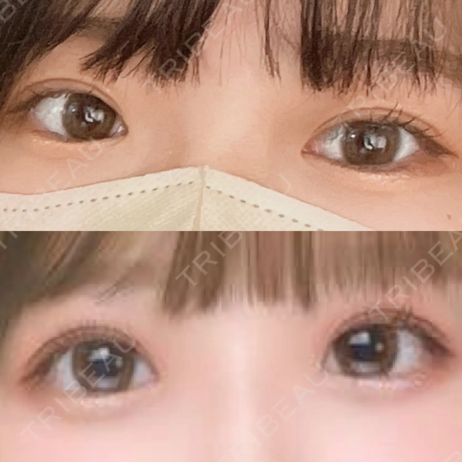 施術後の写真