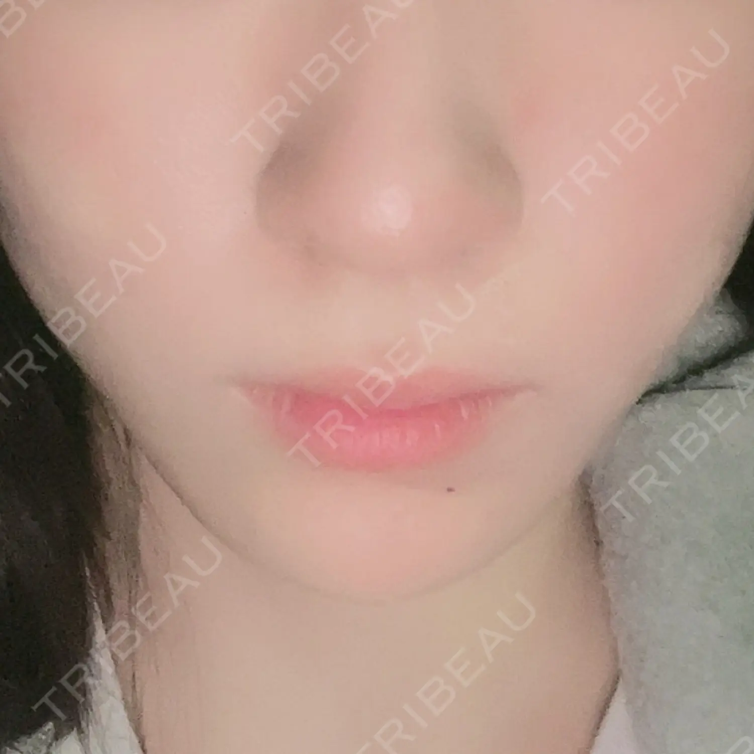 施術後の写真