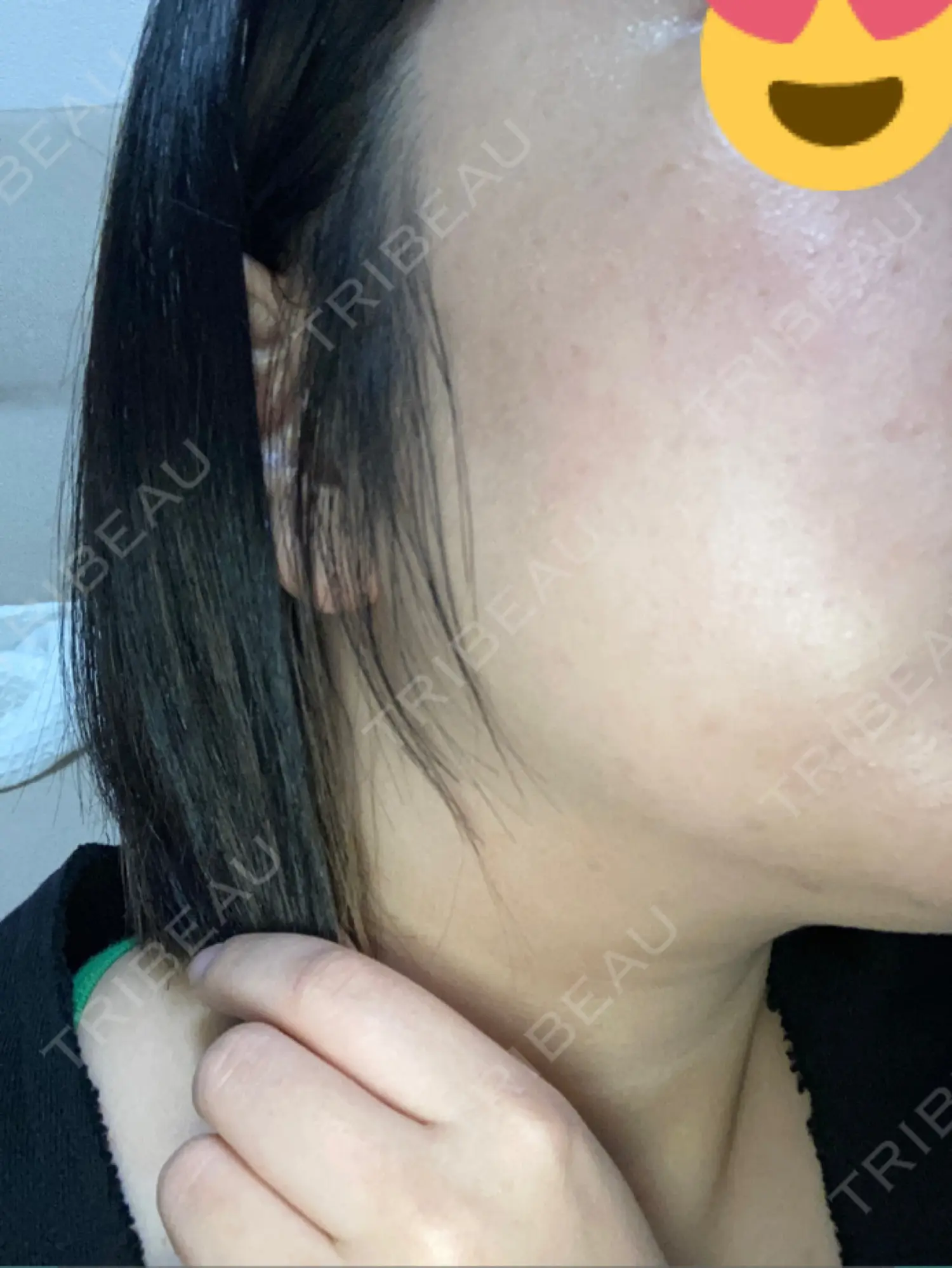 施術後の写真