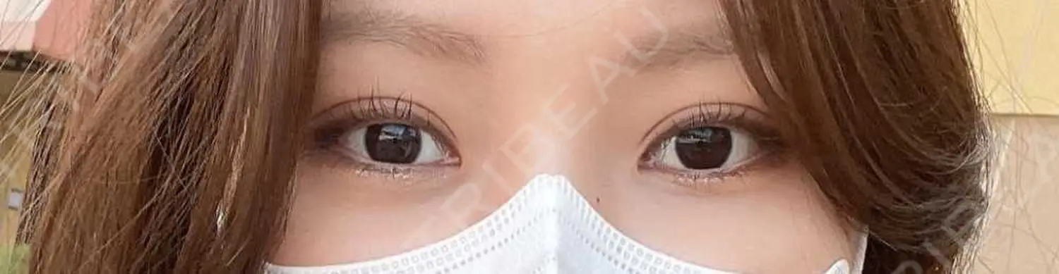 施術後の写真