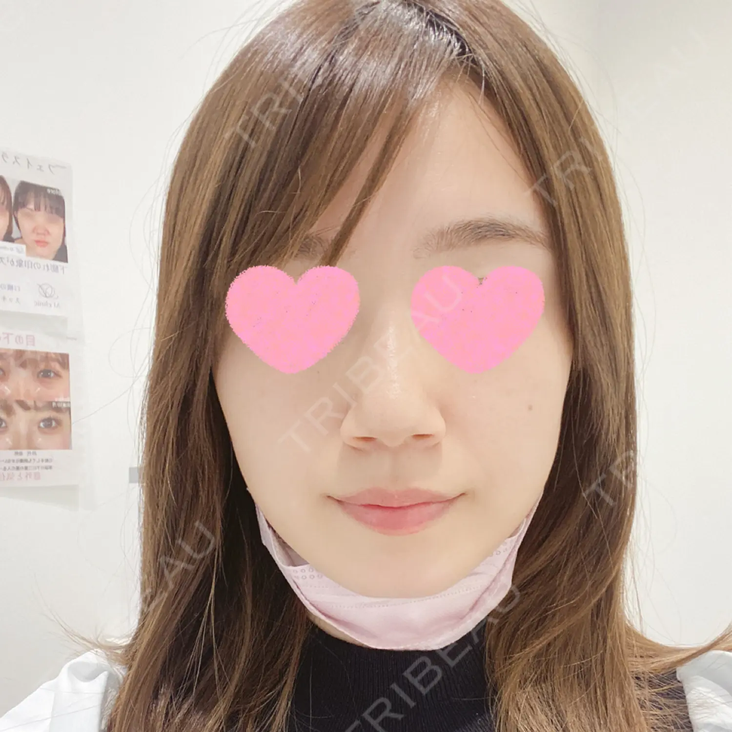 施術後の写真