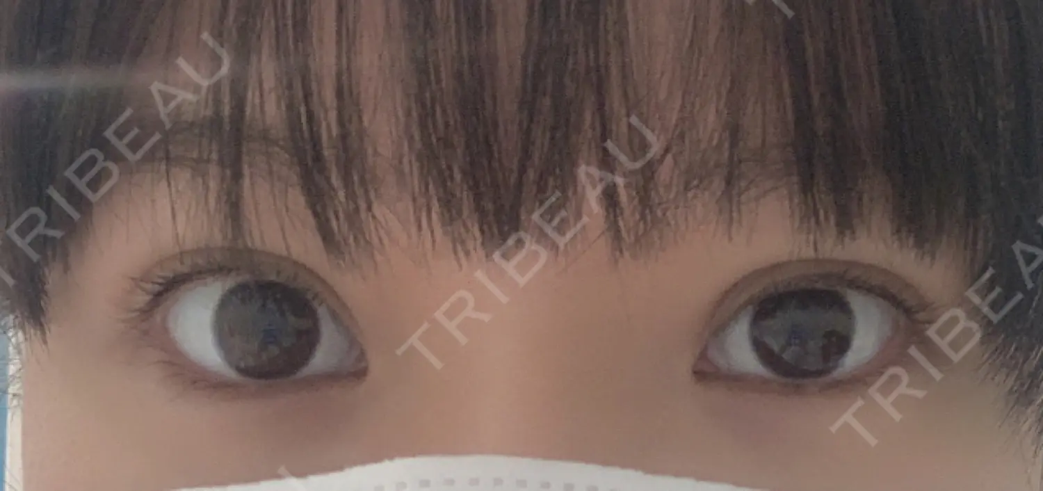 施術後の写真