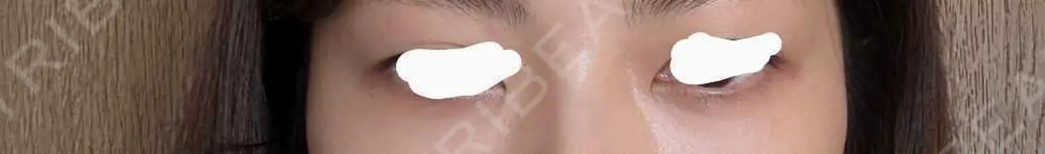 施術後の写真