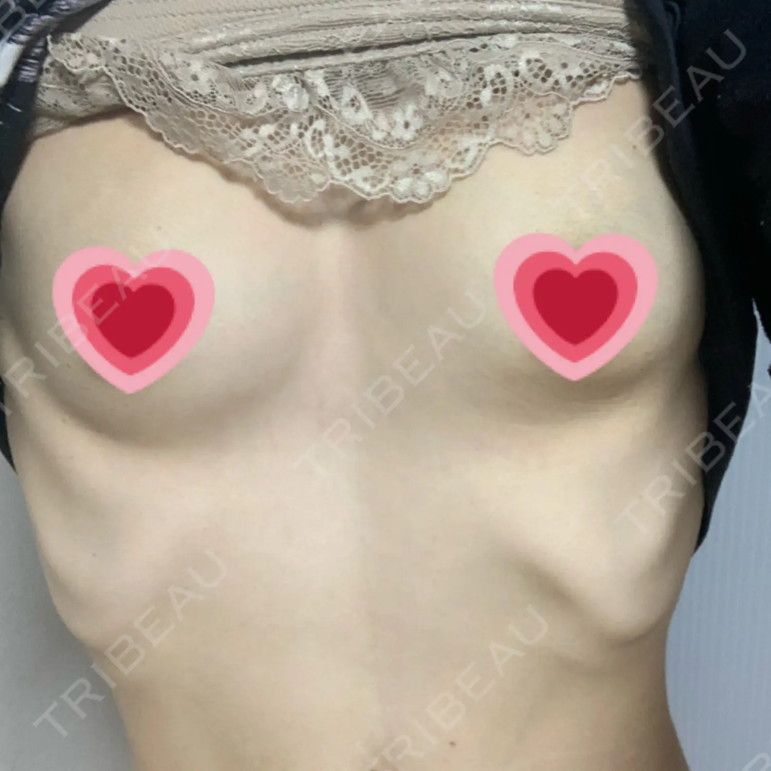 施術後の写真