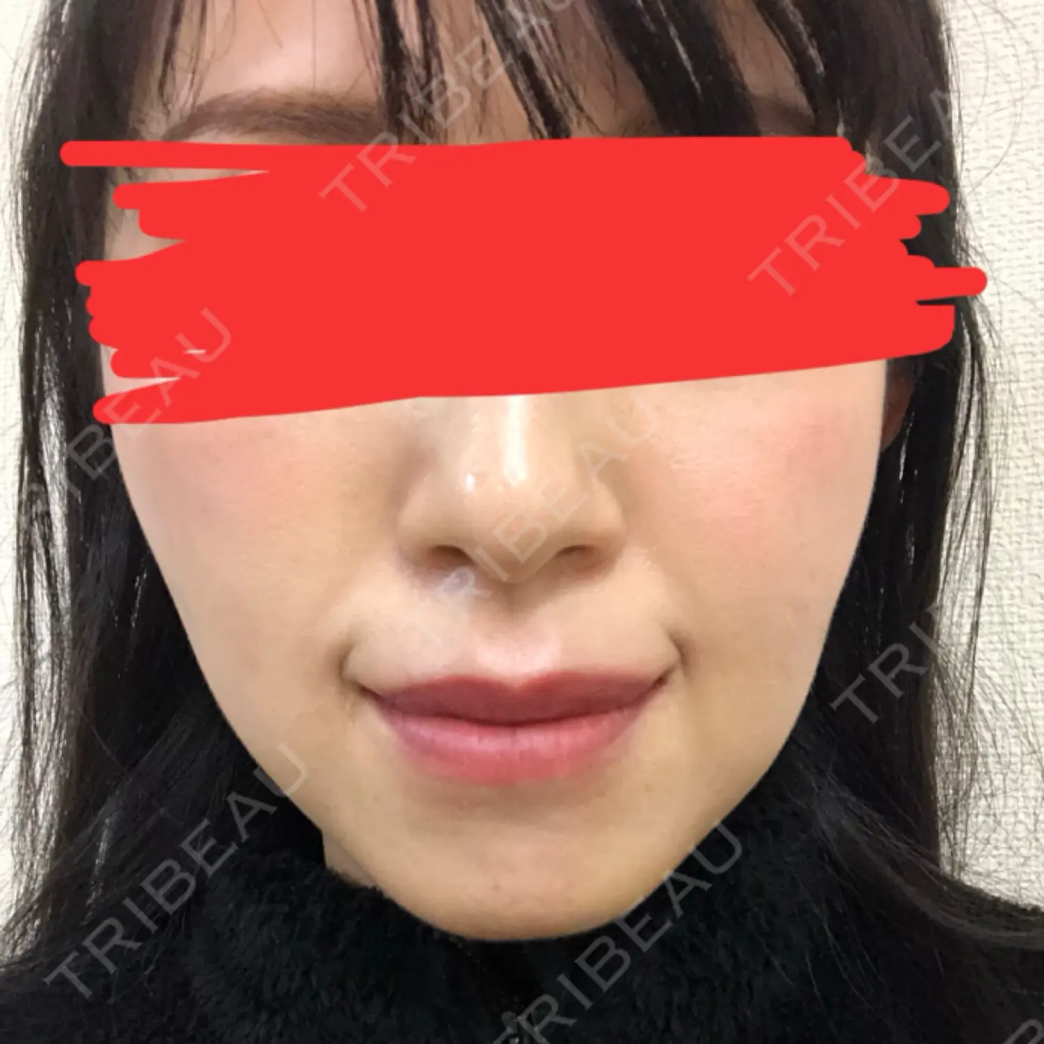 施術後の写真