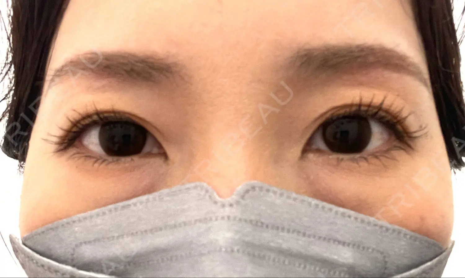 施術後の写真