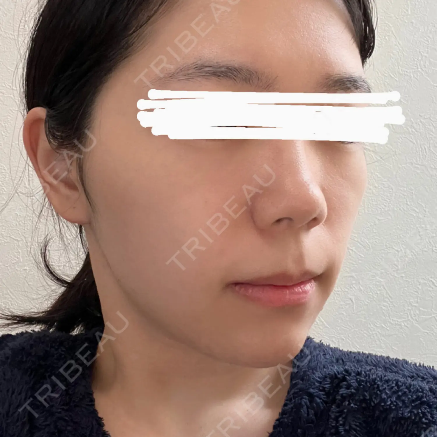 施術後の写真