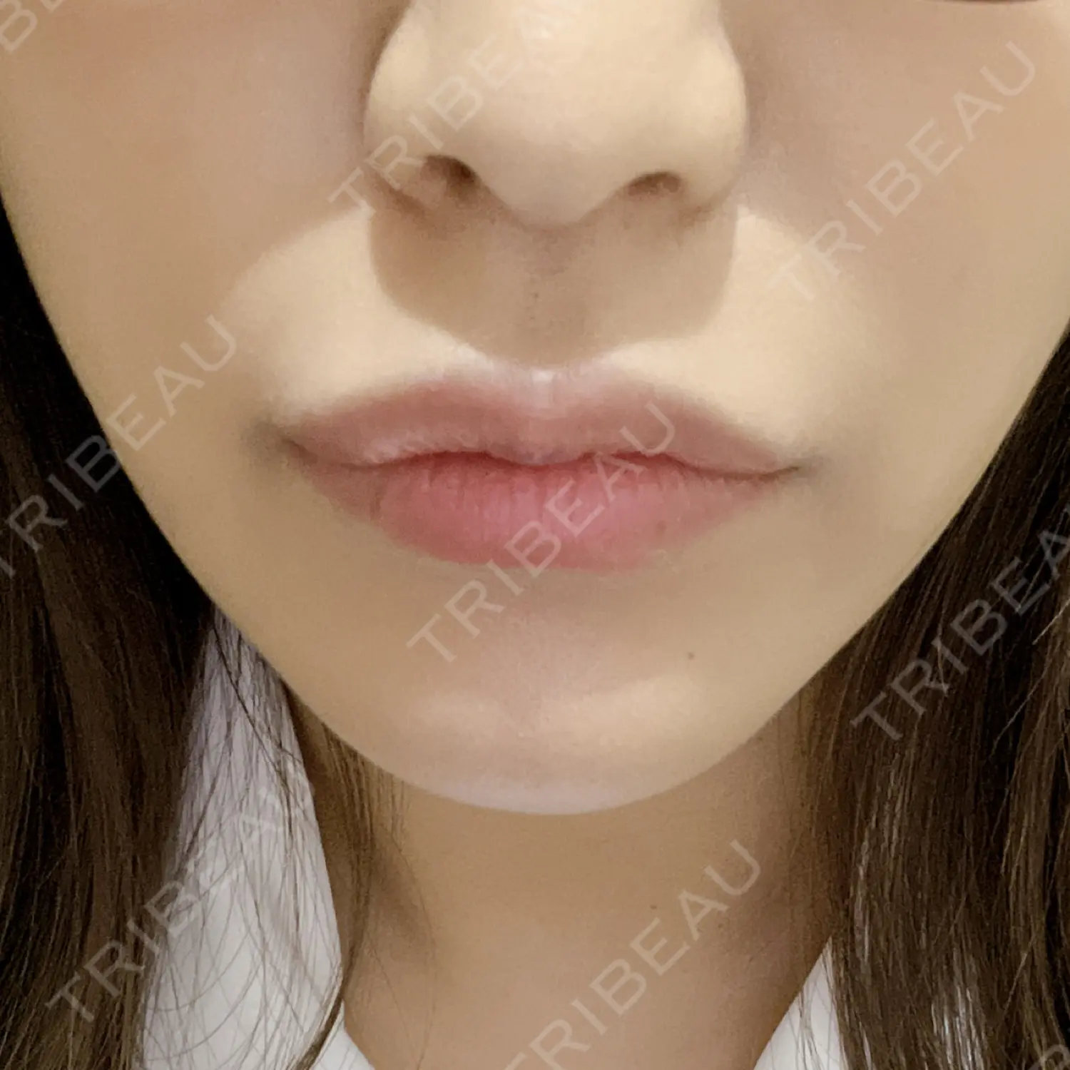 施術後の写真
