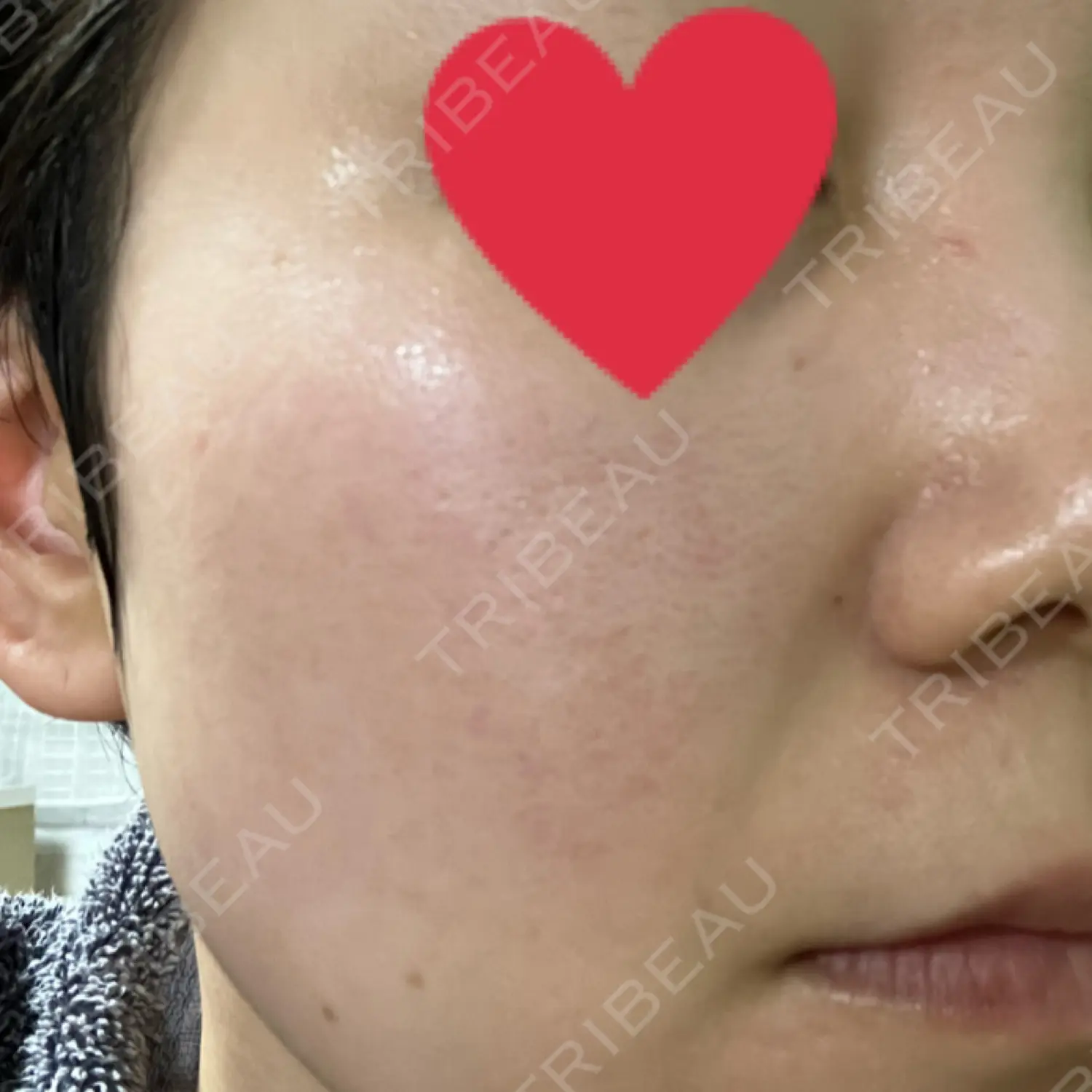 施術後の写真