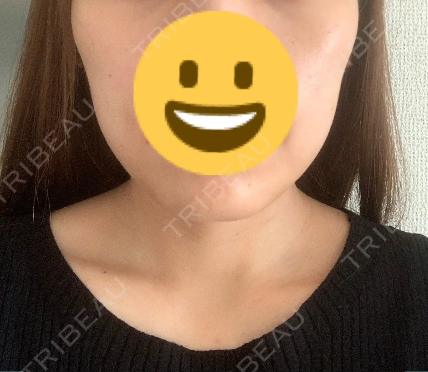 施術後の写真