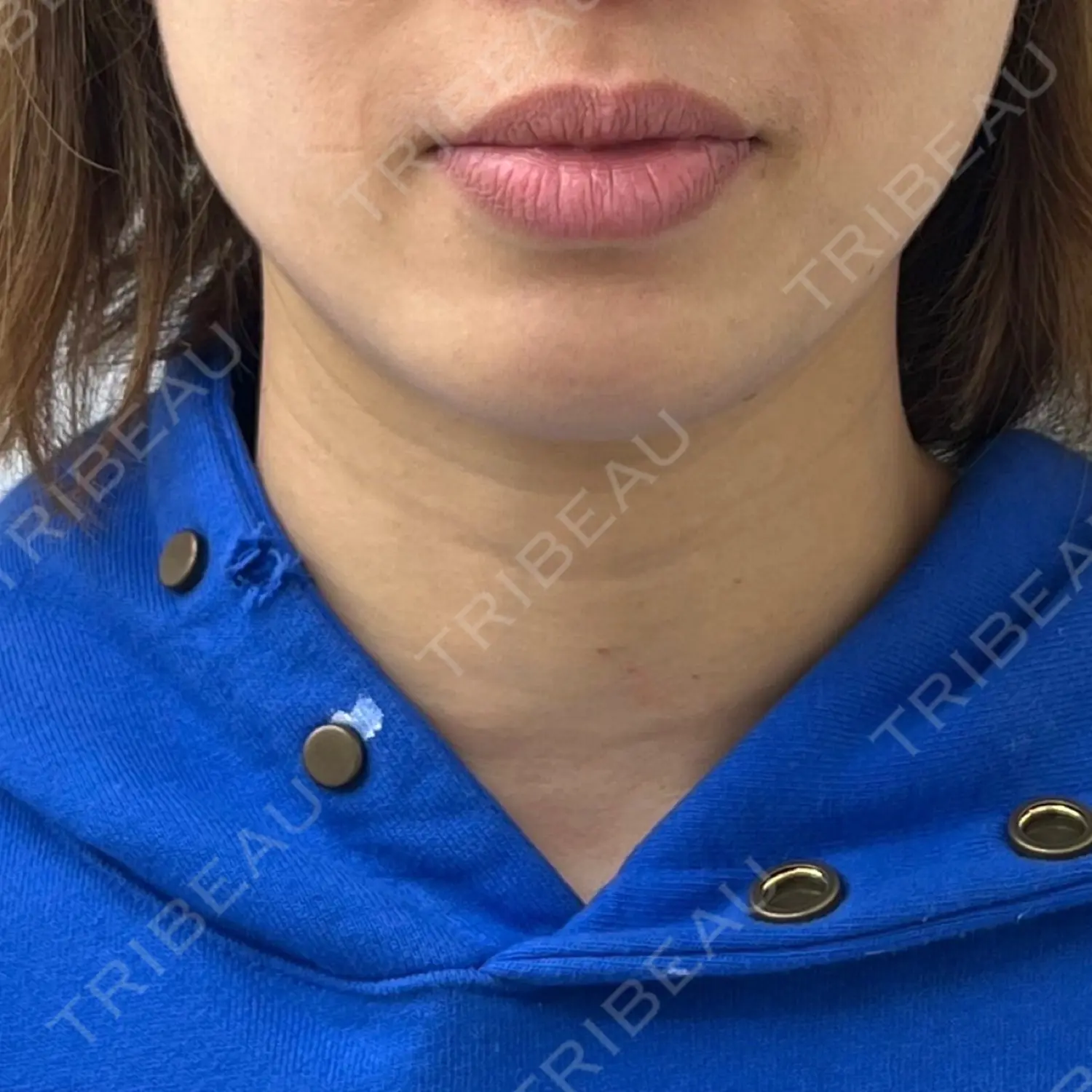 施術後の写真