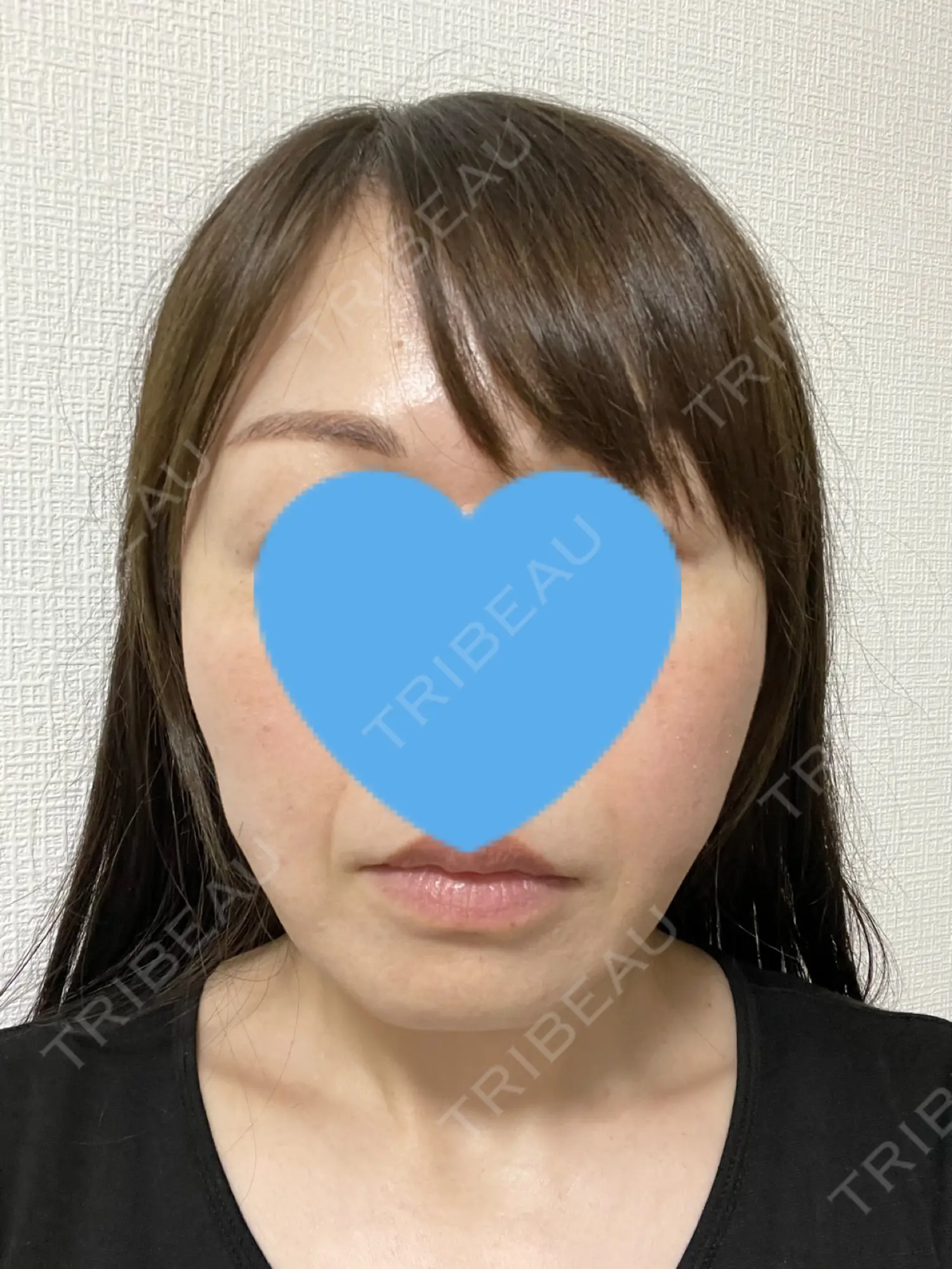 施術後の写真