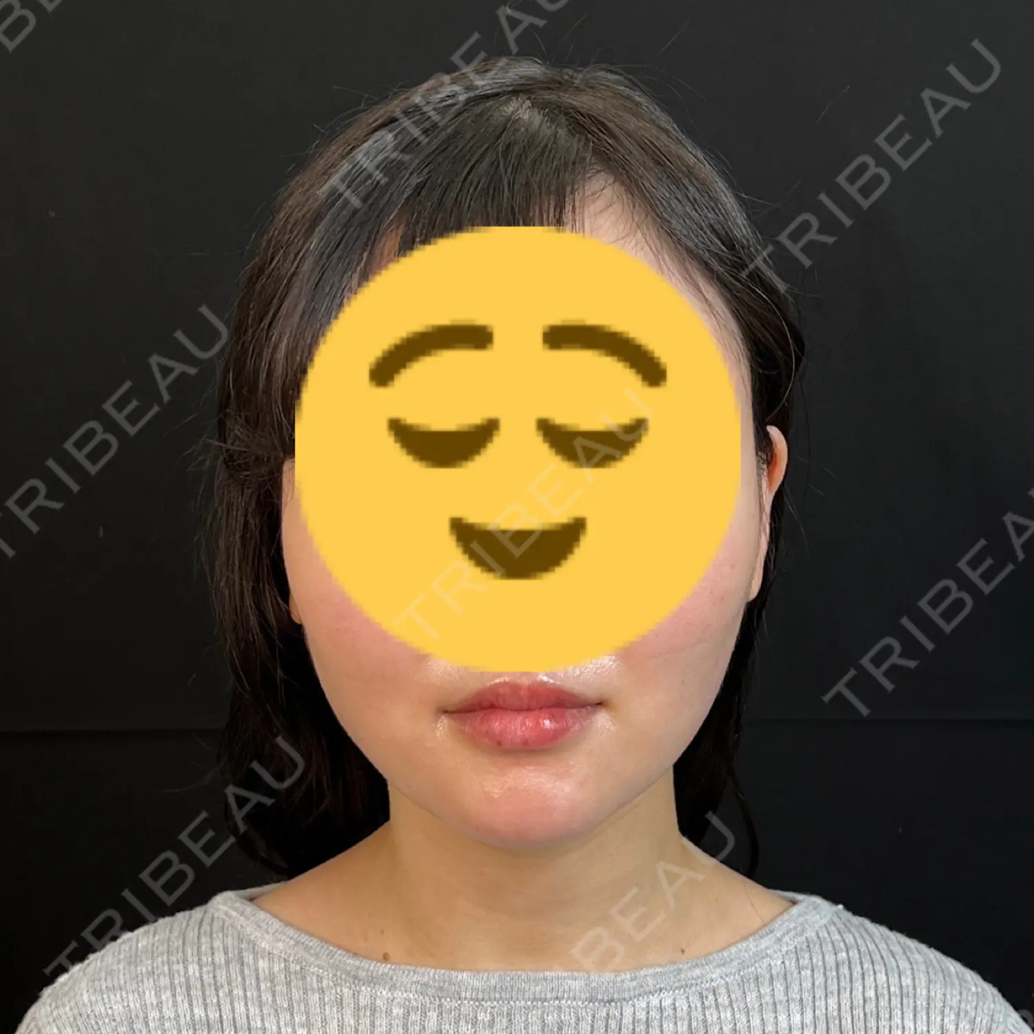 施術後の写真