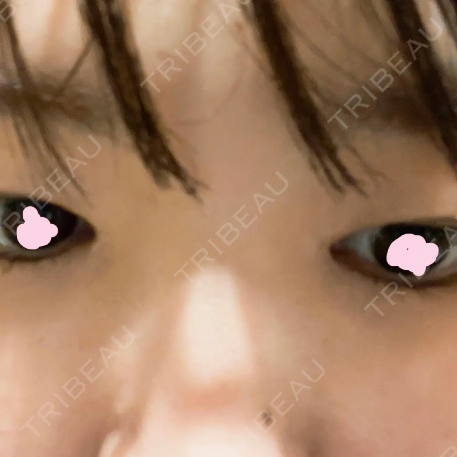 施術後の写真