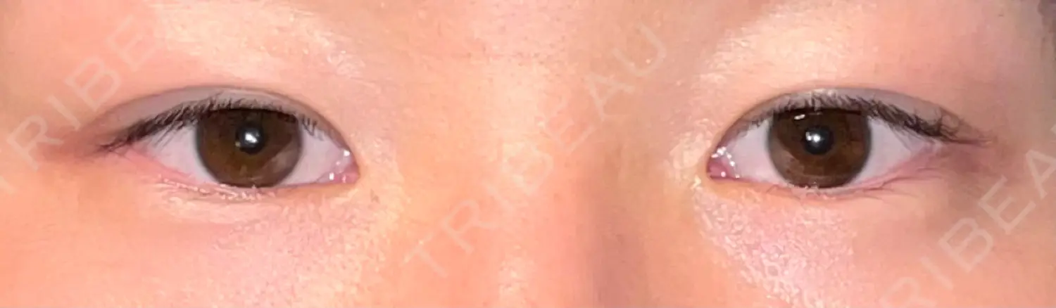 施術後の写真