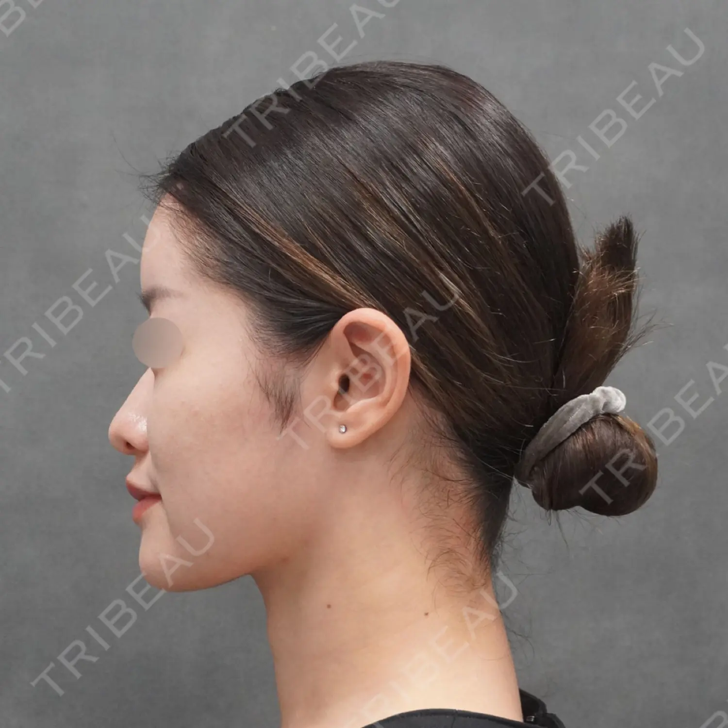 施術後の写真