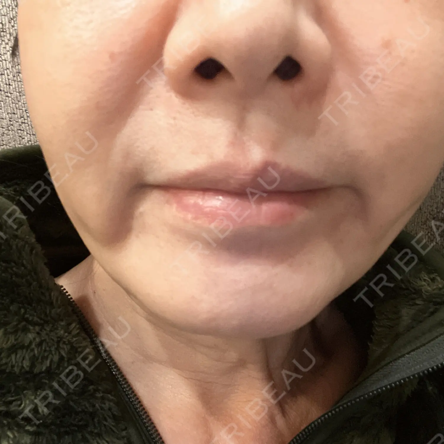 施術後の写真