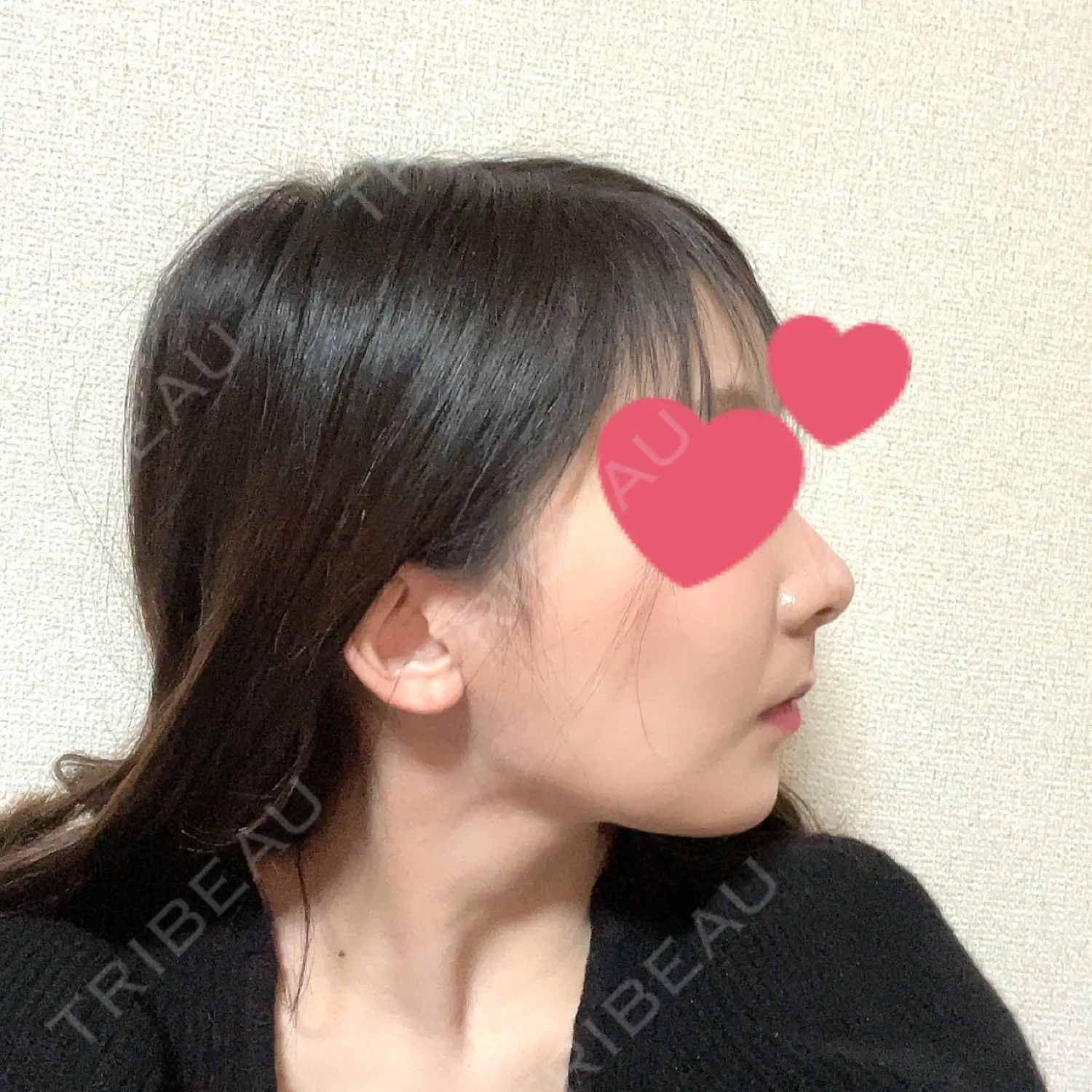 施術後の写真