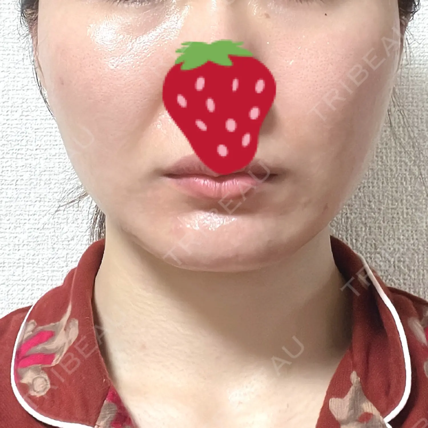 施術後の写真