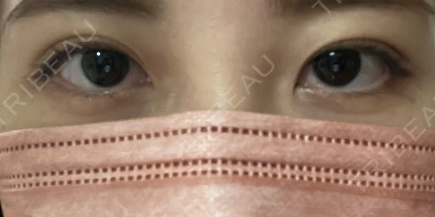施術後の写真