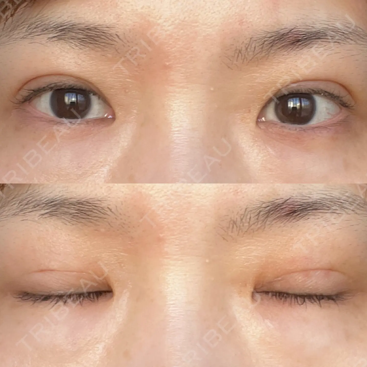 施術後の写真