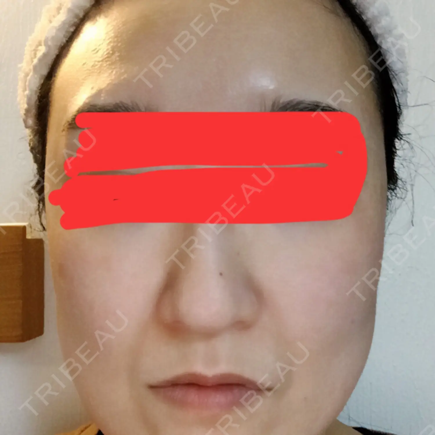 施術後の写真