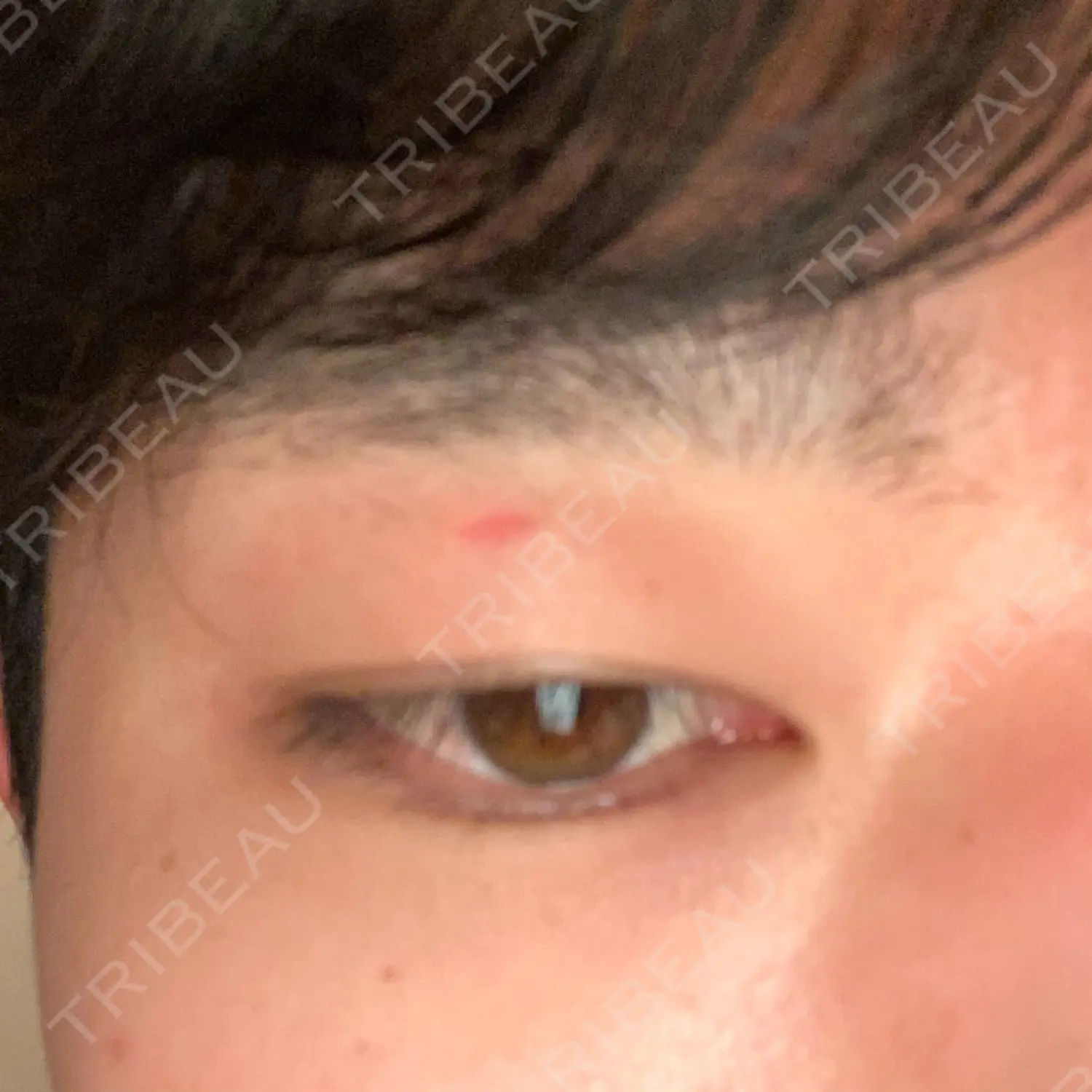 施術後の写真