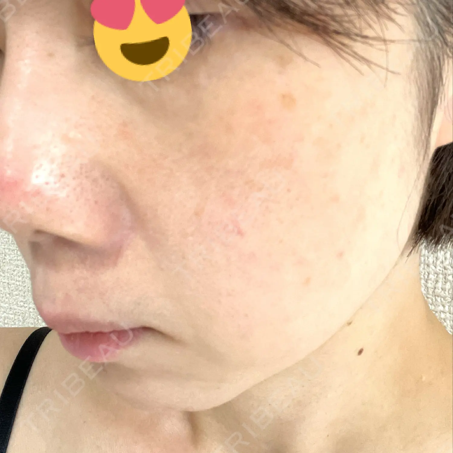施術後の写真