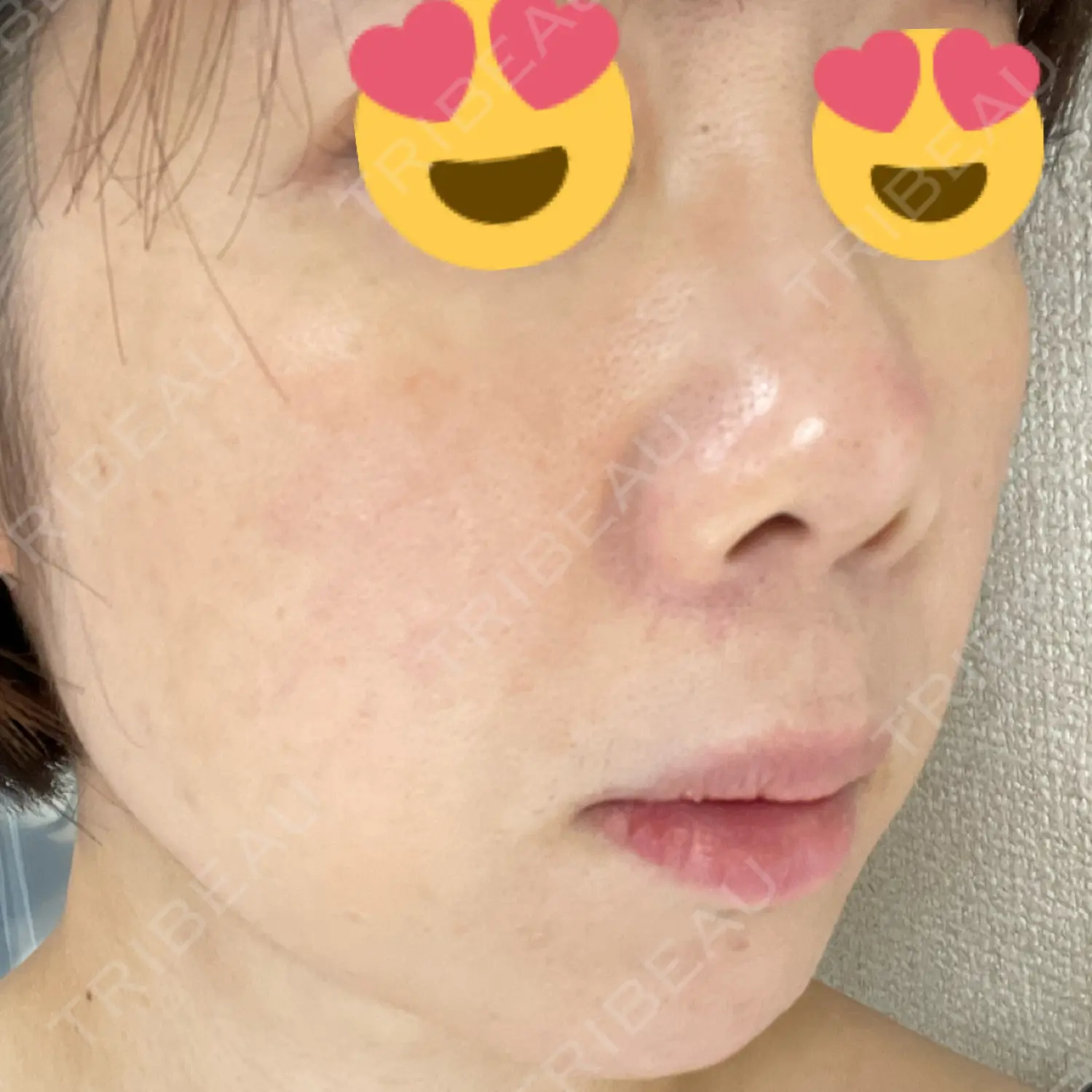 施術後の写真