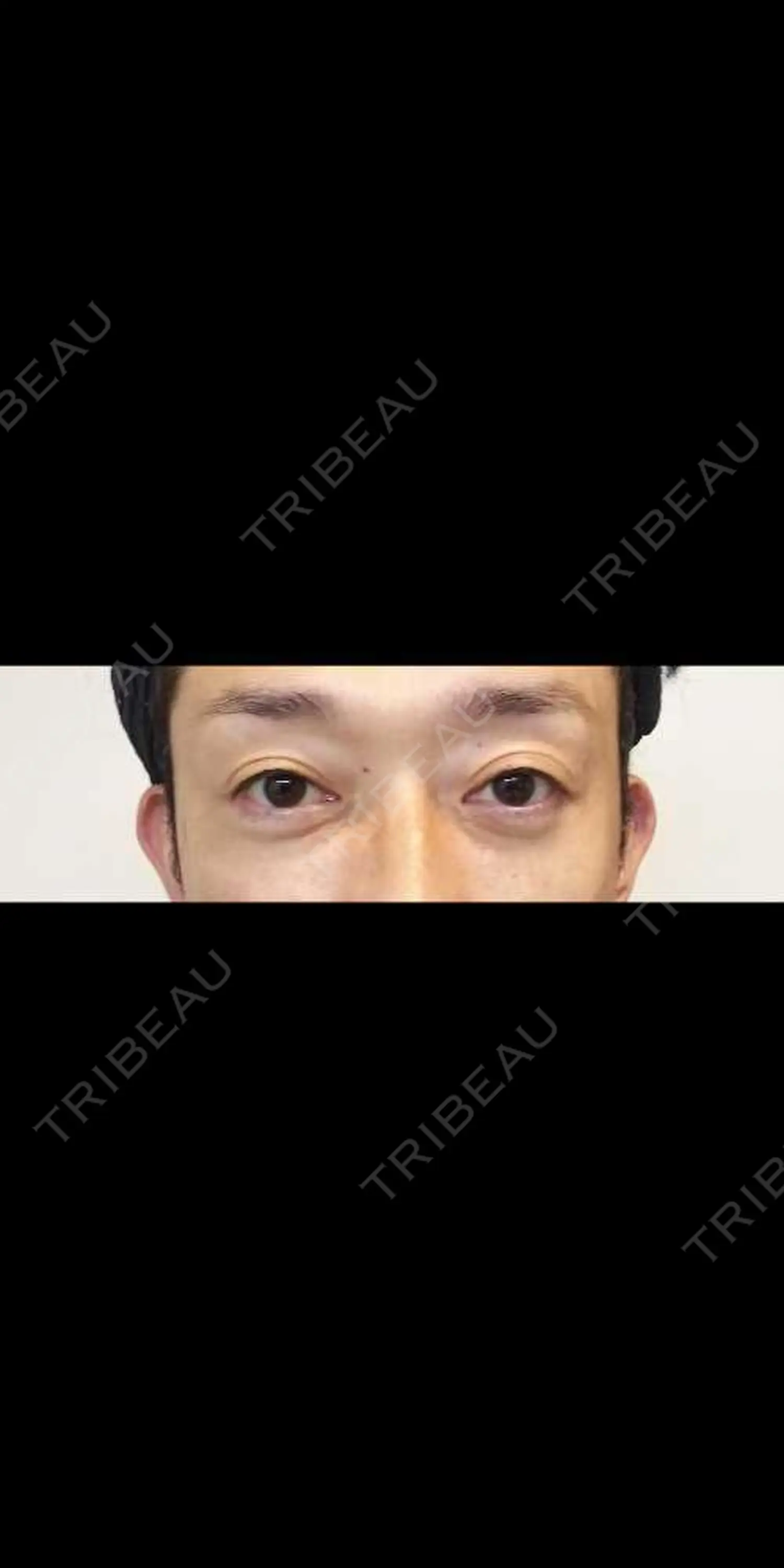 施術後の写真