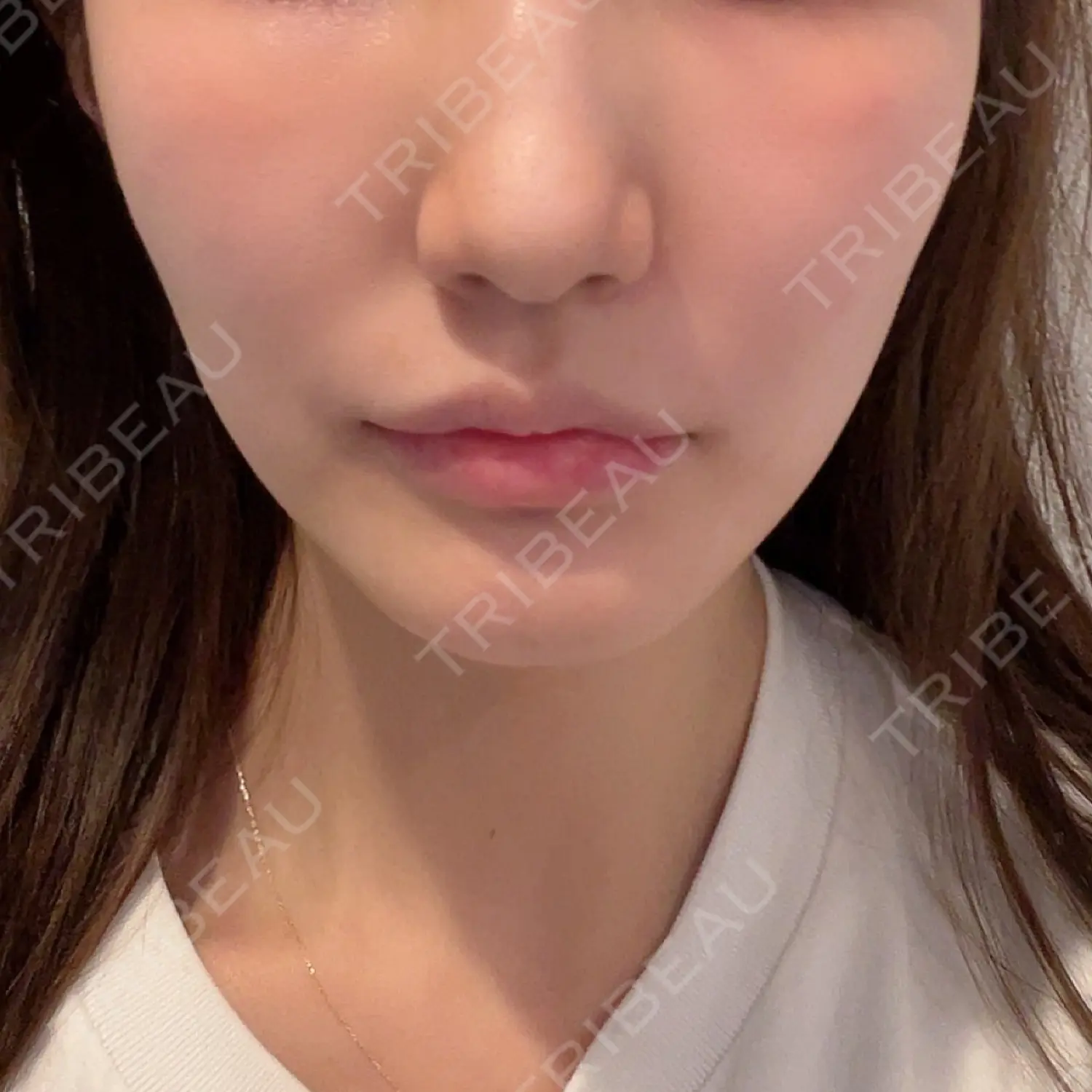 施術後の写真