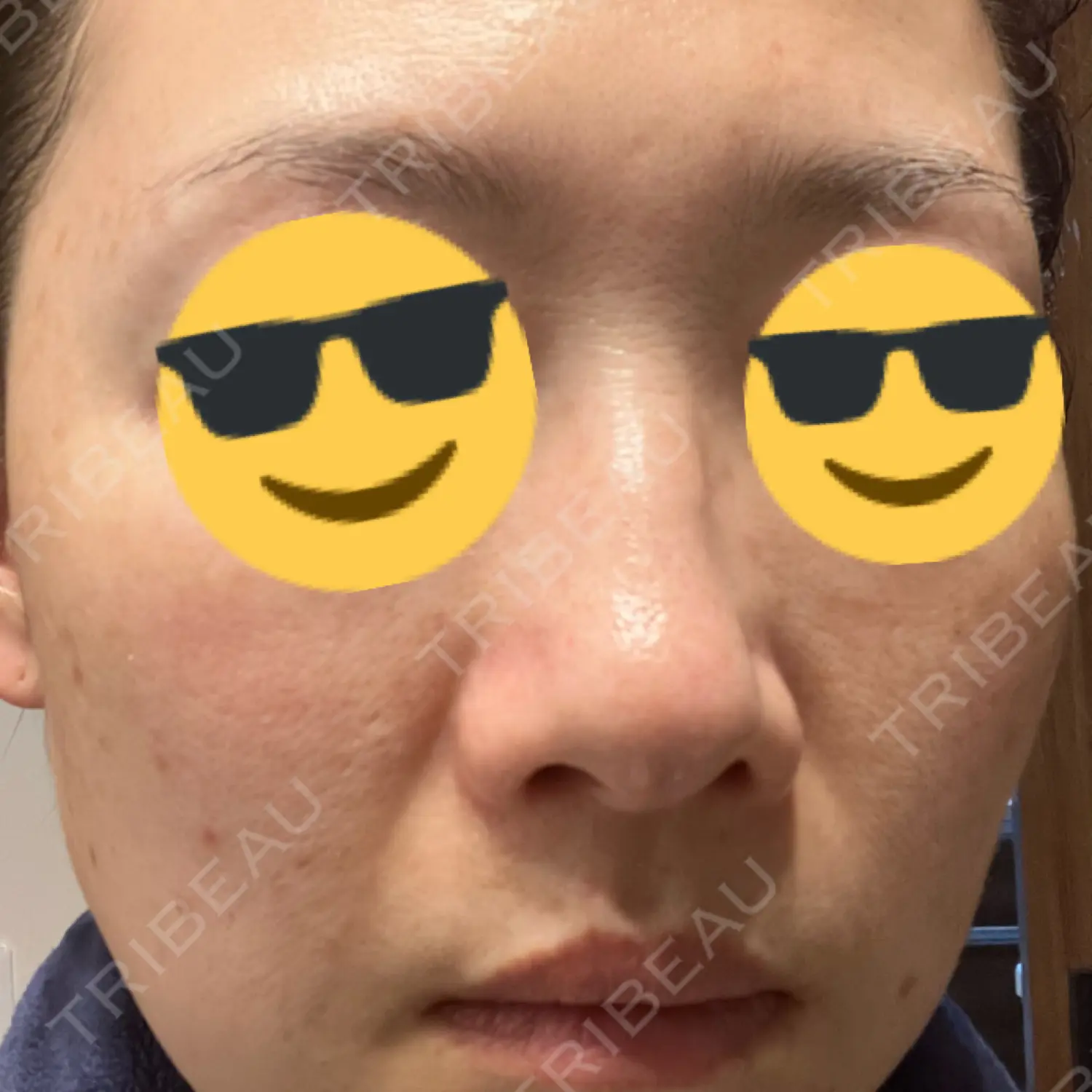 施術後の写真