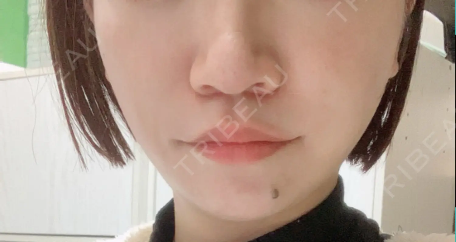 施術後の写真