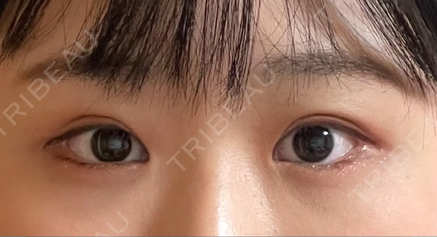 施術後の写真