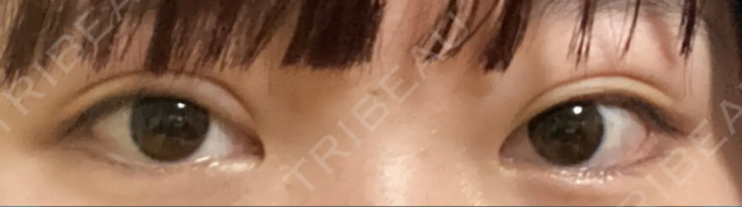 施術後の写真
