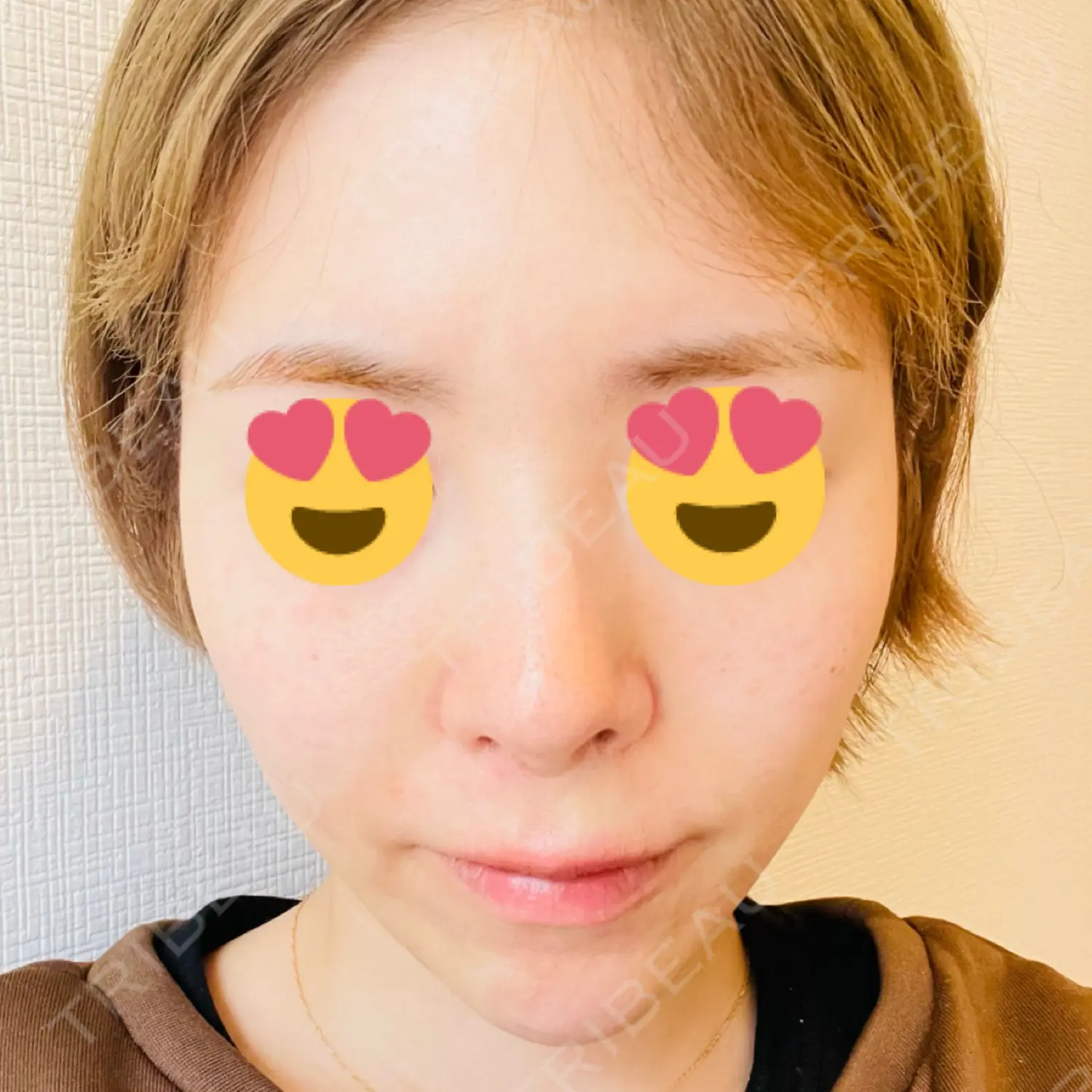 施術後の写真
