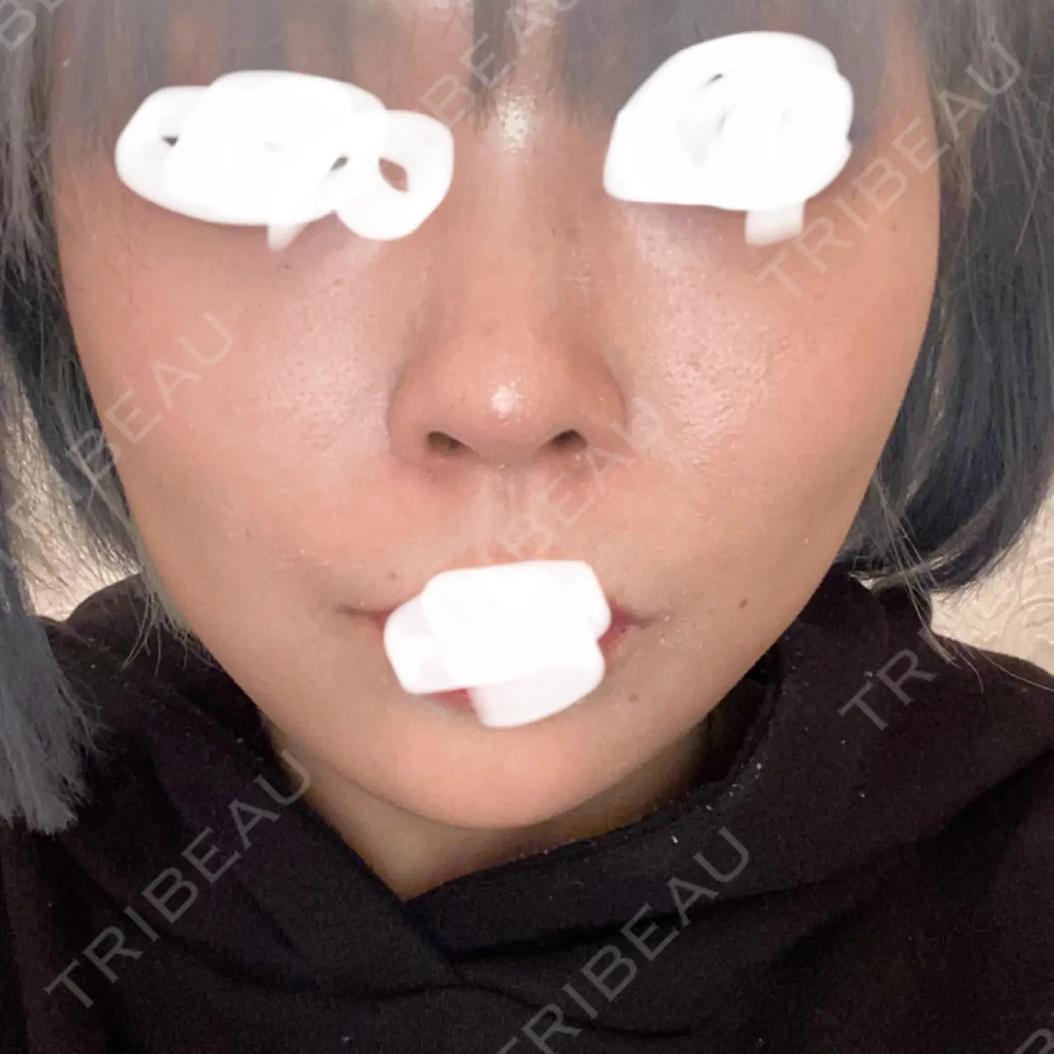 施術後の写真