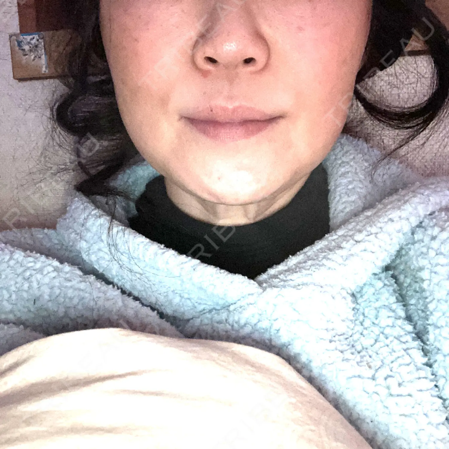 施術後の写真
