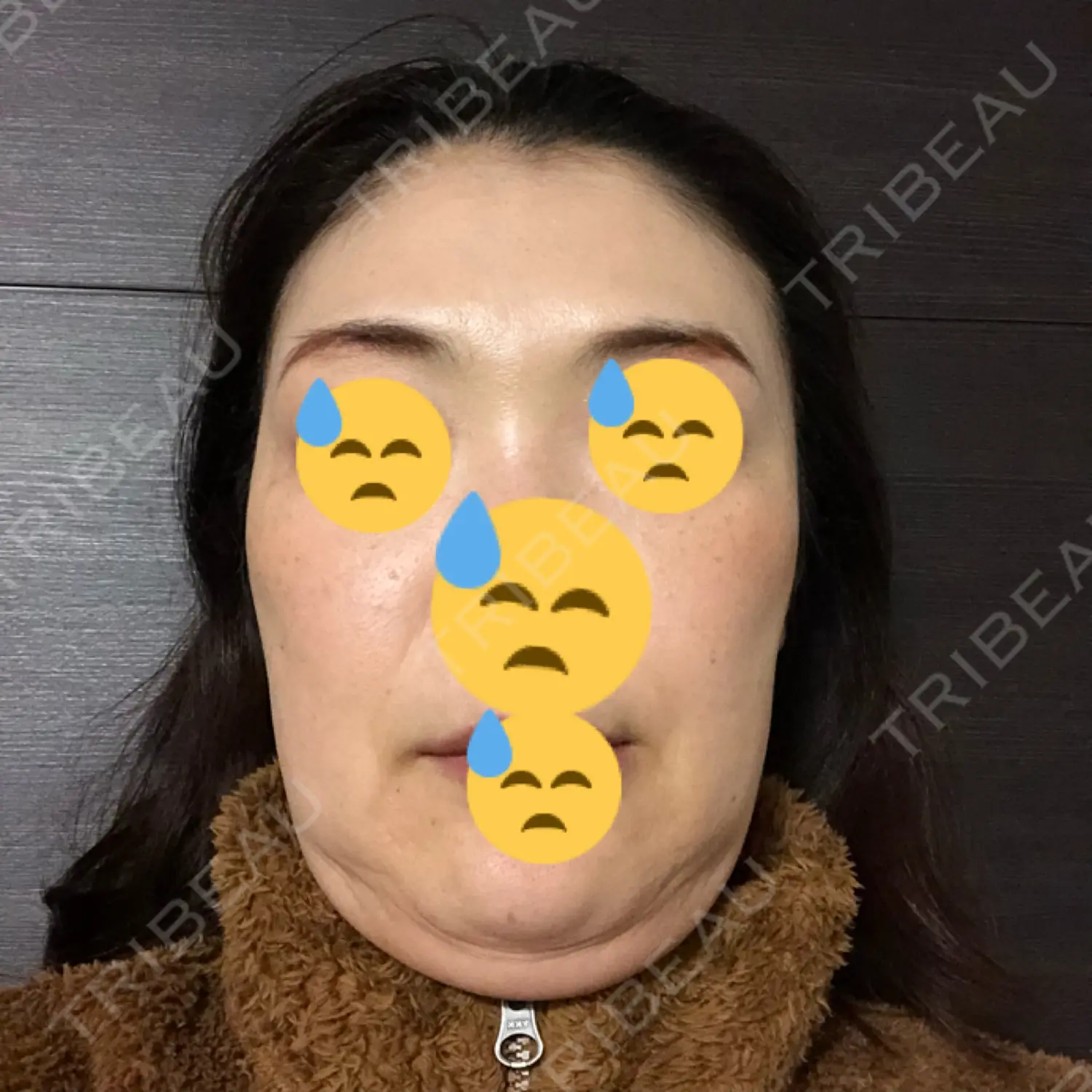 施術後の写真
