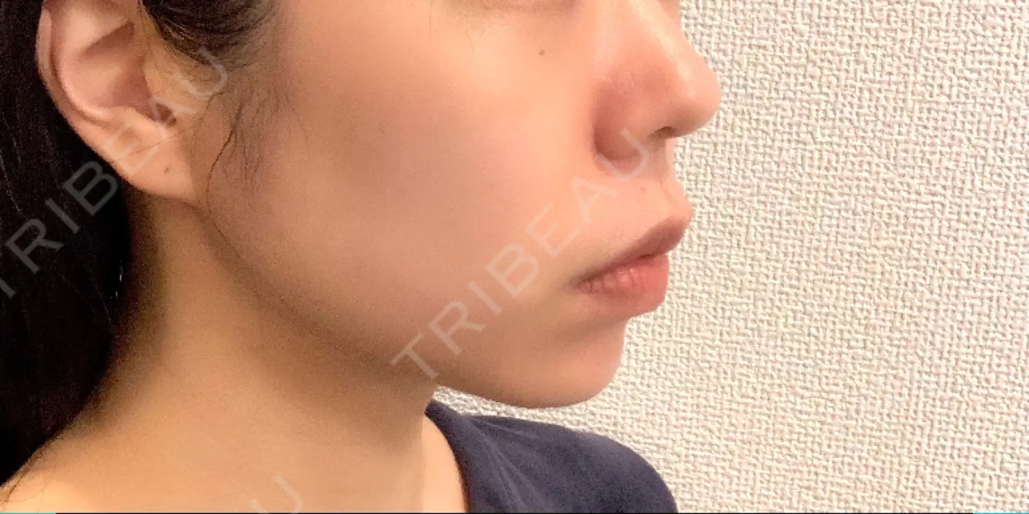 施術後の写真