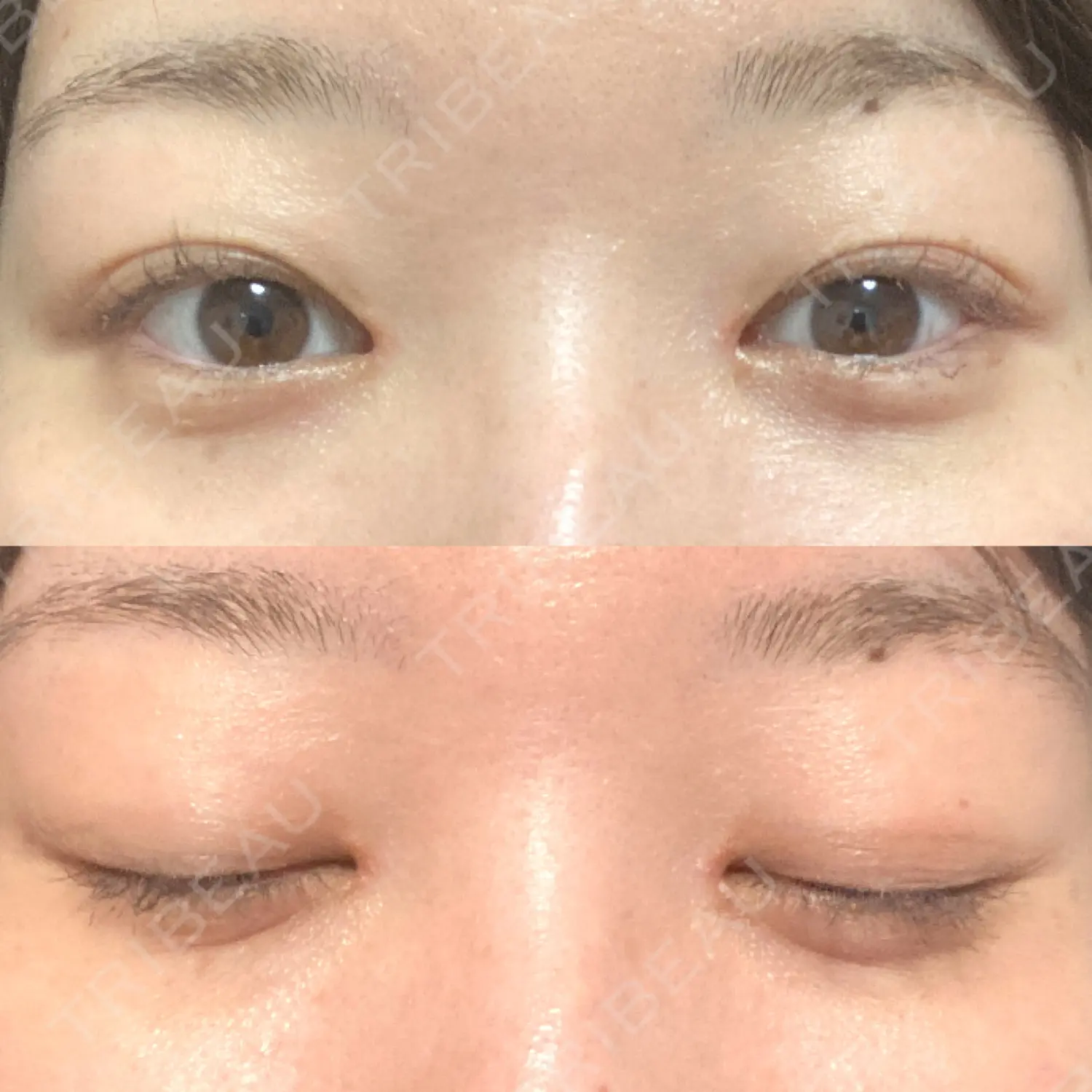 施術後の写真